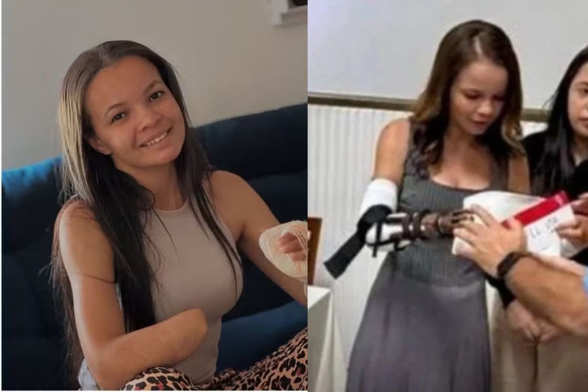 Jovem que teve mão decepada pelo ex luta em Anápolis luta por prótese biônica de R$ 416 mil