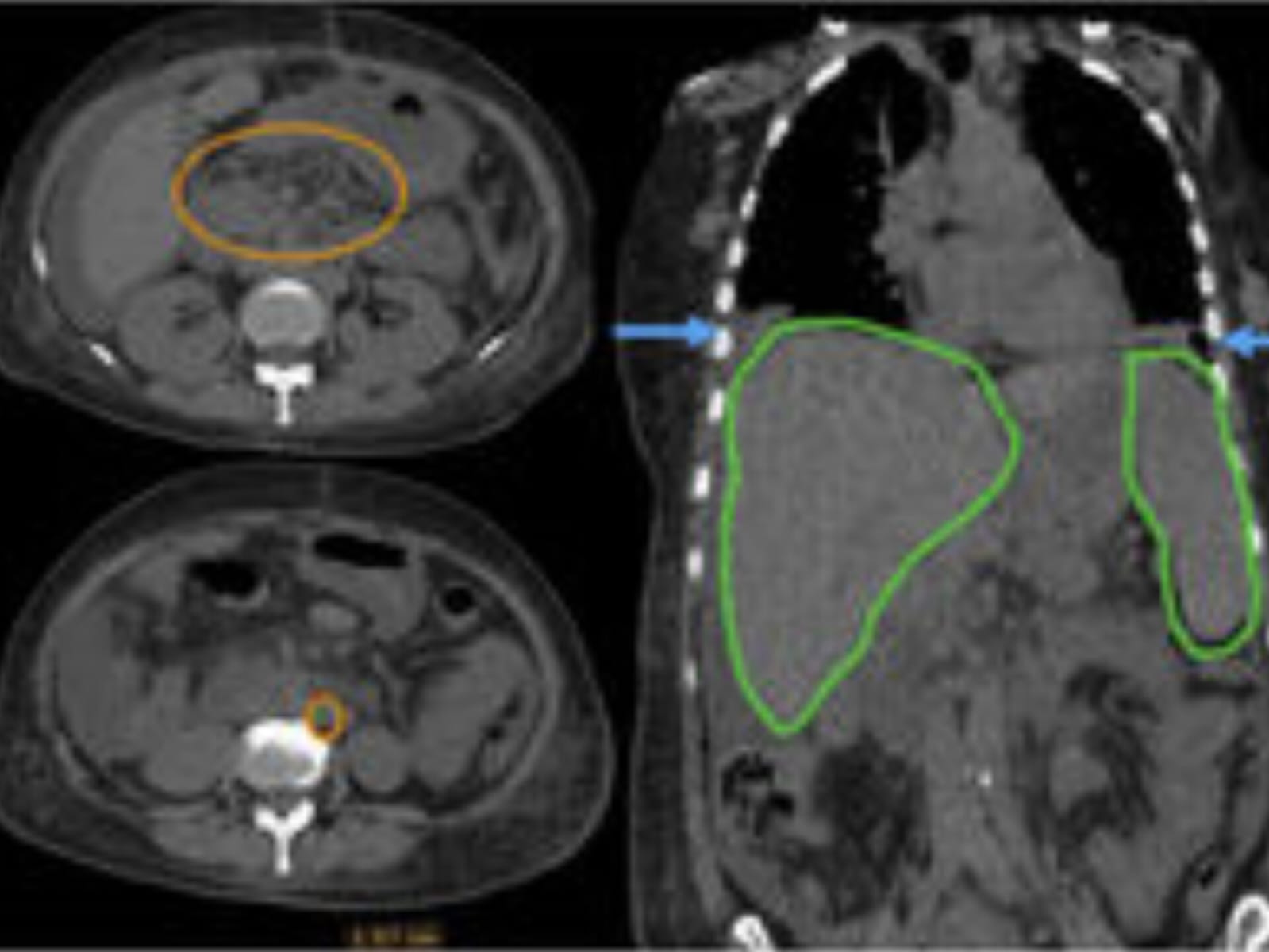 Doença fatal e pouco conhecida avança no Brasil e acende alerta de especialistas