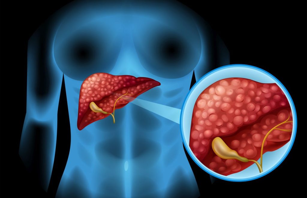 A gordura no fígado costuma surgir sem sinais claros e, na maioria dos casos, melhora quando o corpo volta a ter equilíbrio com mudanças simples e consistentes na rotina