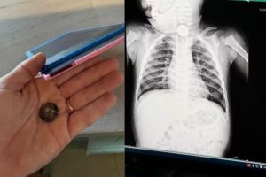 Mãe faz alerta após bebê engolir bateria de brinquedo e ir parar no hospital em Goiânia