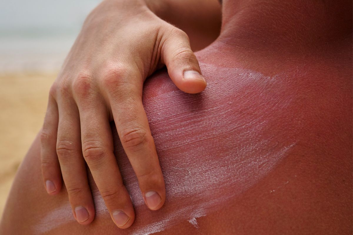 queimaduras de sol : veja qual a solução