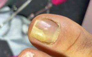 Micose nas unhas é um problema comum. Veja como uma misturinha caseira pode ajudar a combater fungos em casos leves.