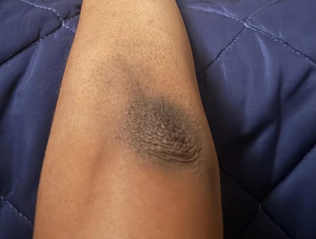 Por que os cotovelos escurecem? A ciência revela a causa e a melhor forma de clareá-los