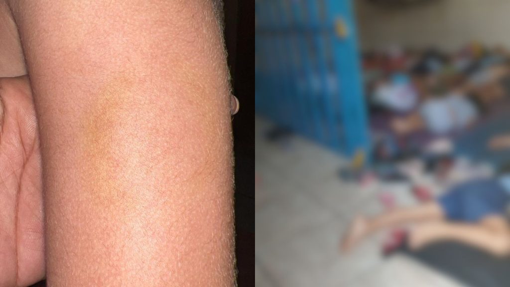 Mãe denuncia que filho foi mordido pela diretora do berçário.