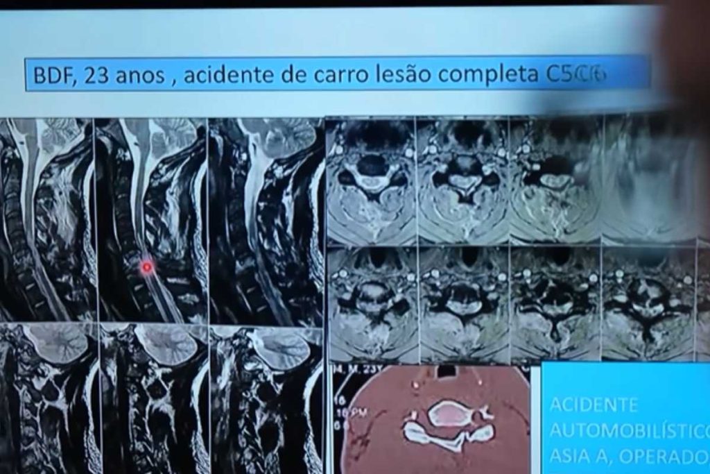 Polilaminina: saiba por que nem todo paciente pode usar