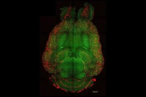 Estudos com Lecanemab e Donanemab mostram remoção de placas do Alzheimer e desaceleração dos sintomas em pacientes nos estágios iniciais da doença.