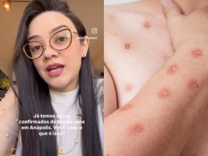Médica explicou principais pontos sobre a mpox. (Foto: Instagram/@andressahirako)