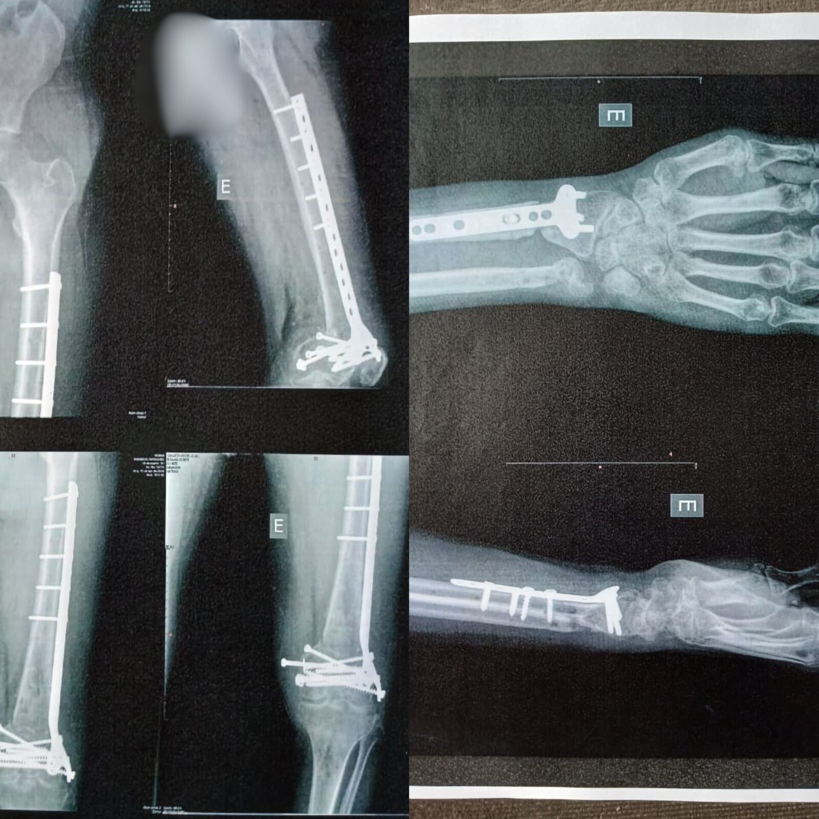 Ferimentos deixados pelo acidente. (Foto: Arquivo Pessoal)