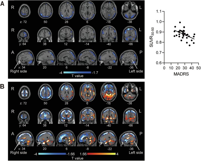 Scanner cerebral revela como a cetamina age no cérebro de pacientes com depressão