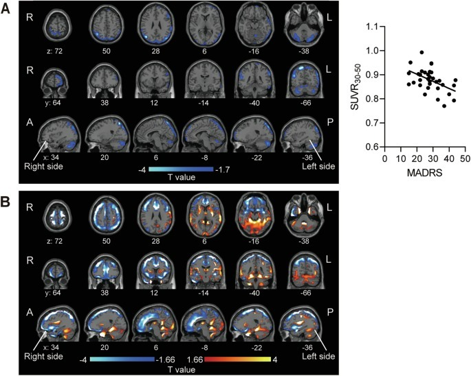 Scanner cerebral revela como a cetamina age no cérebro de pacientes com depressão
