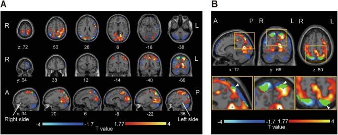Scanner cerebral revela como a cetamina age no cérebro de pacientes com depressão