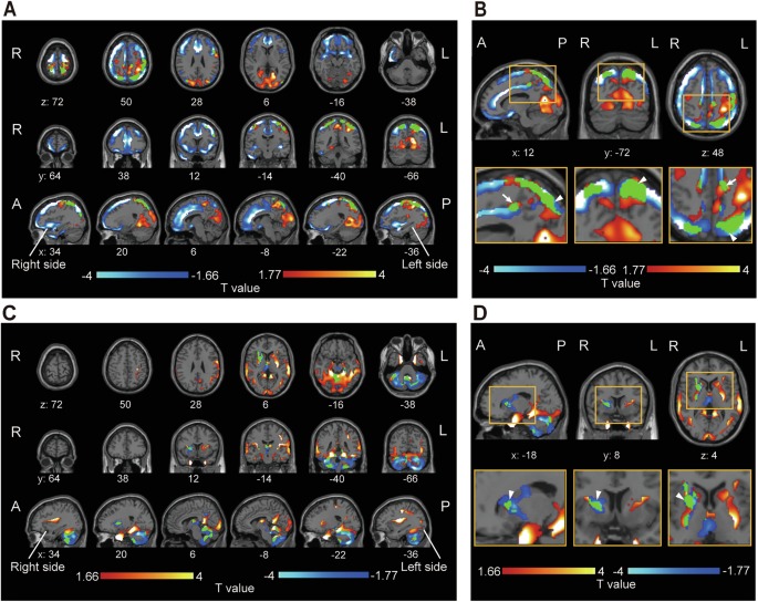 Scanner cerebral revela como a cetamina age no cérebro de pacientes com depressão