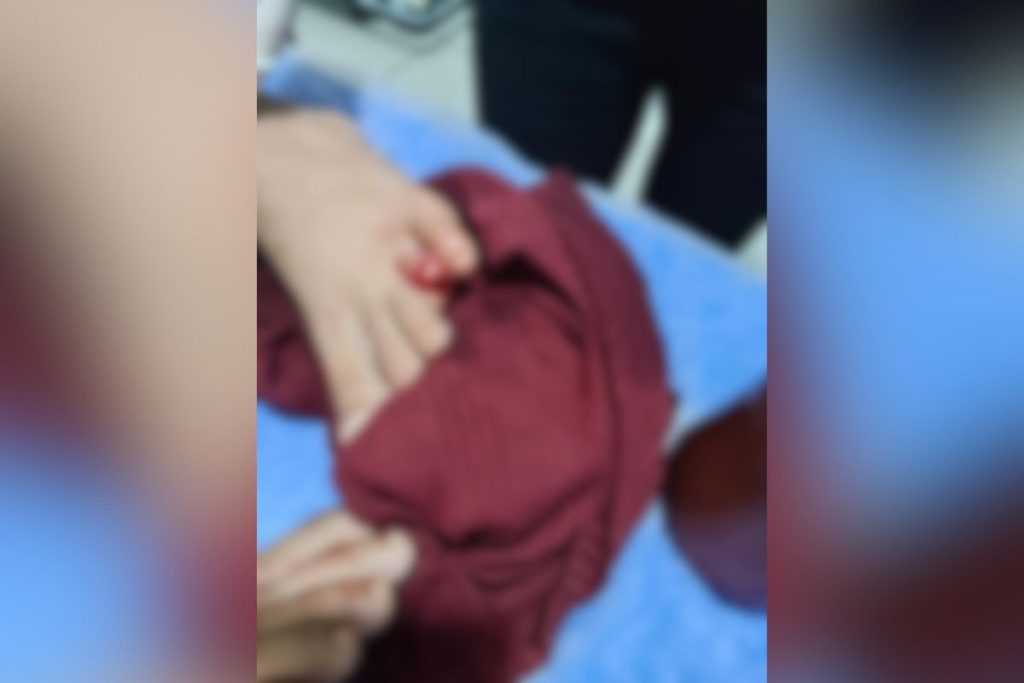 Criança perde parte do dedo após ataque de piranhas no Lago Corumbá, em Caldas Novas