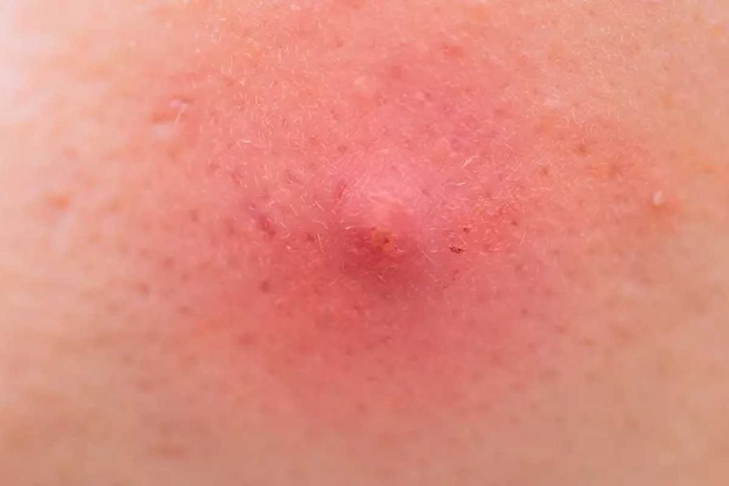 Furúnculos: por que nascem e como evitar