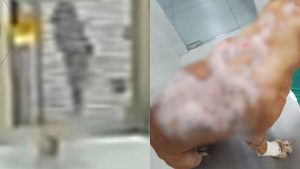 Cão comunitário apelidado de Johnny sofreu queimaduras em cerca de 40% do corpo.