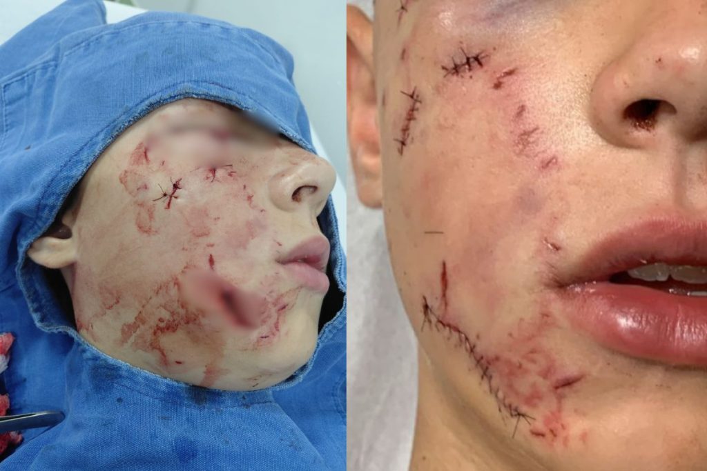 ataque de pitbull em Anápolis