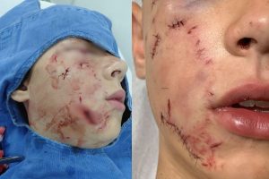 ataque de pitbull em Anápolis