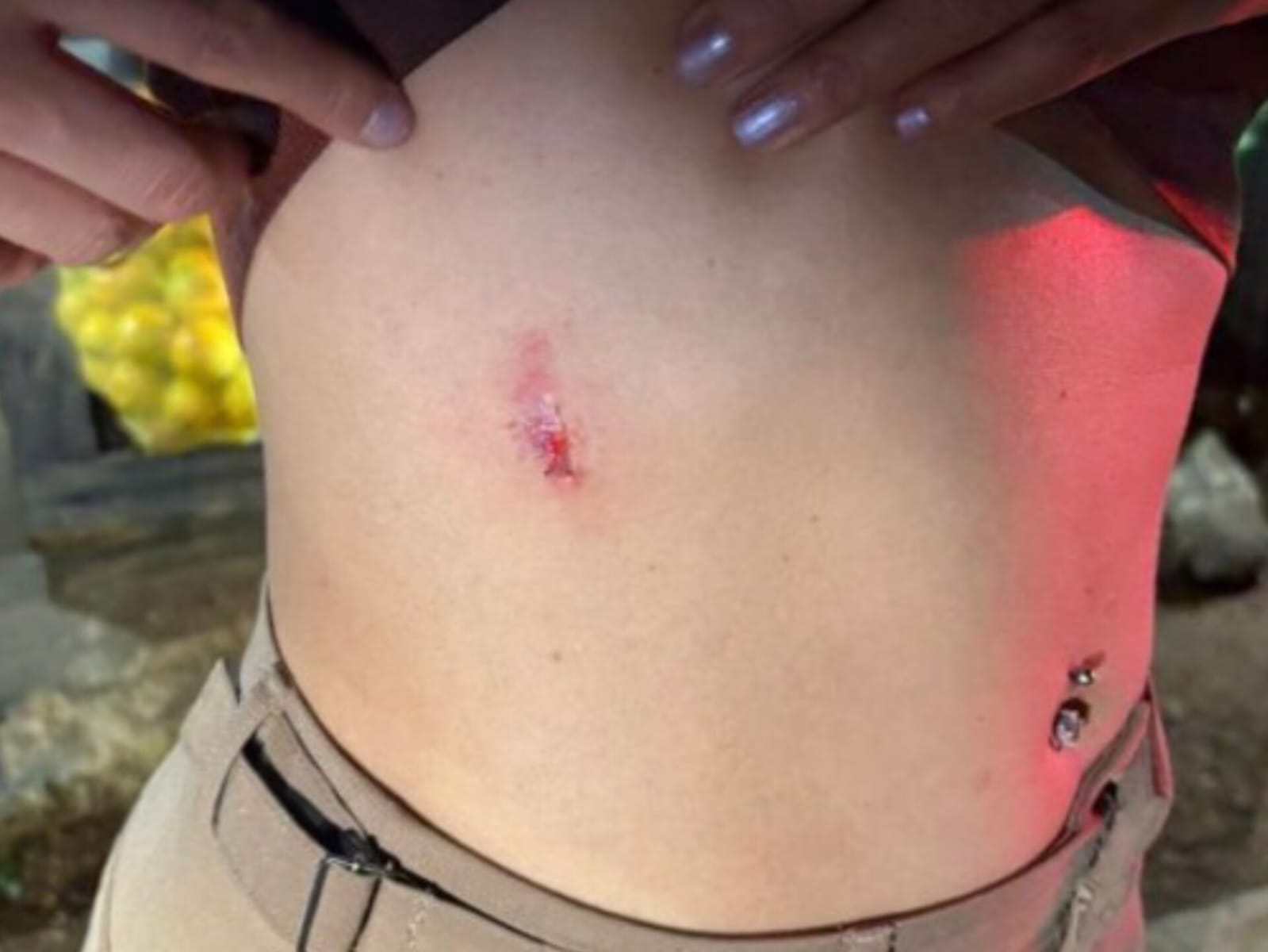 Marcas de agressão deixadas na vítima. (Foto: Reprodução)