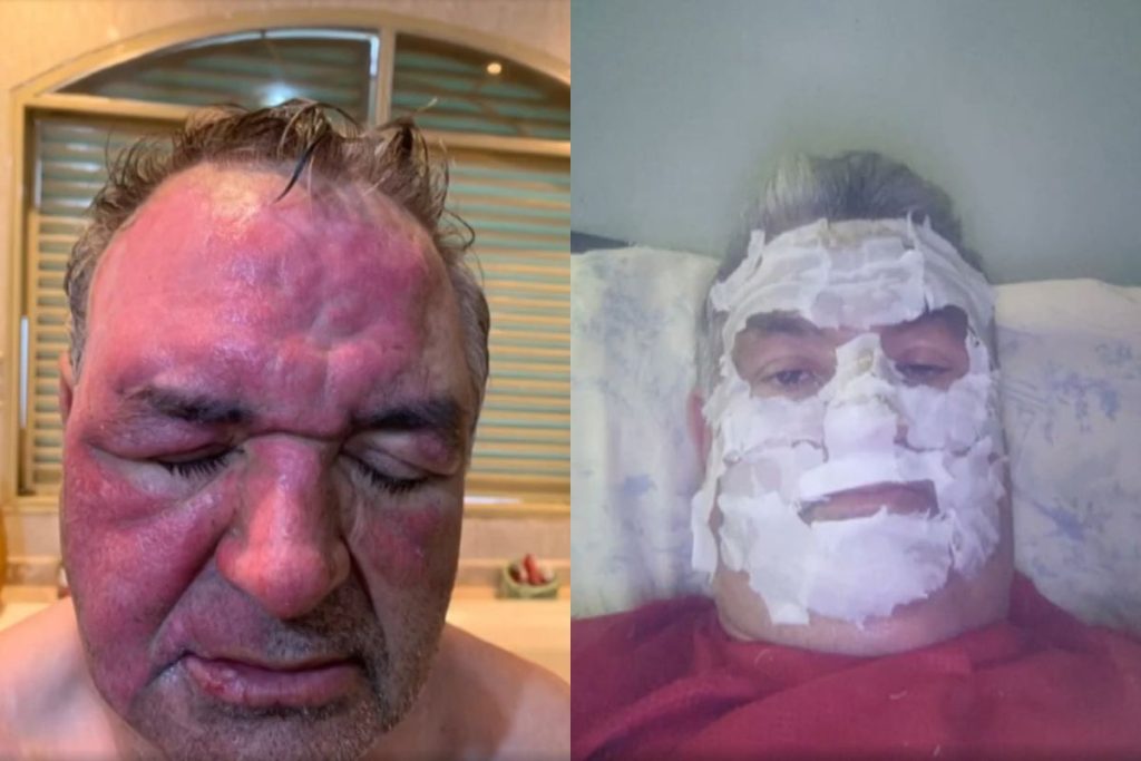 Panela de pressão explode e atinge rosto de comerciante de Anápolis