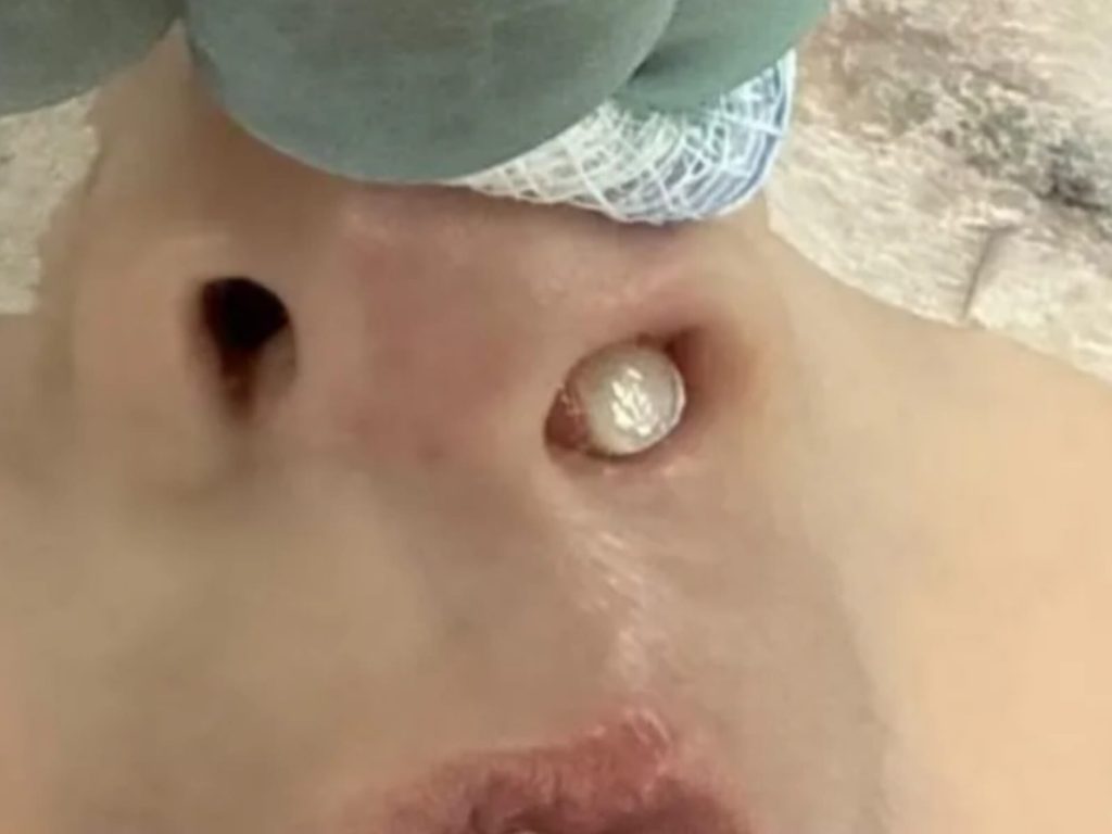 Em caso raro, dente nasce dentro do nariz de criança de 3 anos no Paraná