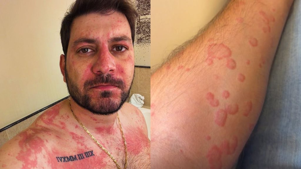 Ex-BBB Caio Afiune compartilhou fotos mostrando a reação alérgica que teve.