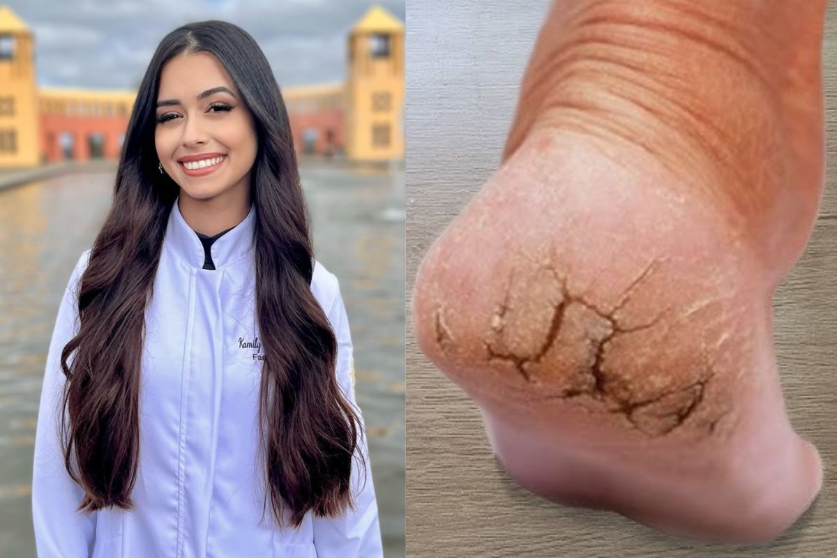 creme com ureia para pé rachado