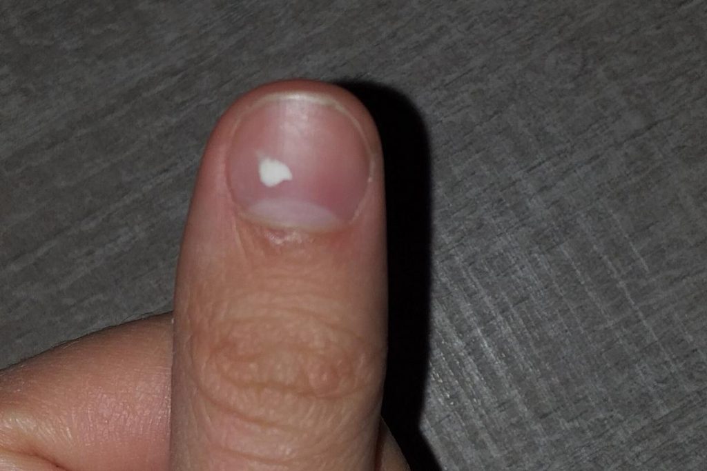 Unhas com manchas brancas: o que significa e por que elas aparecem