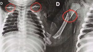 Bebê foi levada ao hospital com vários ossos quebrados.