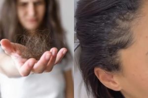 A Queda De Cabelo pode ter diferentes causas, e dermatologistas indicam tratamentos específicos de acordo com o diagnóstico