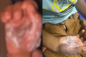 Mãe é presa suspeita de queimar mãos do filho de 7 anos com colher quente em Goiás