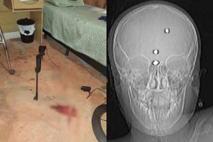 criança atingida por arma de chumbinho