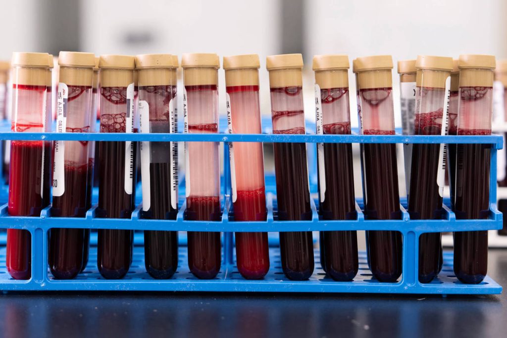 Exame de sangue que busca detectar mais de 50 tipos de câncer chega ao Brasil